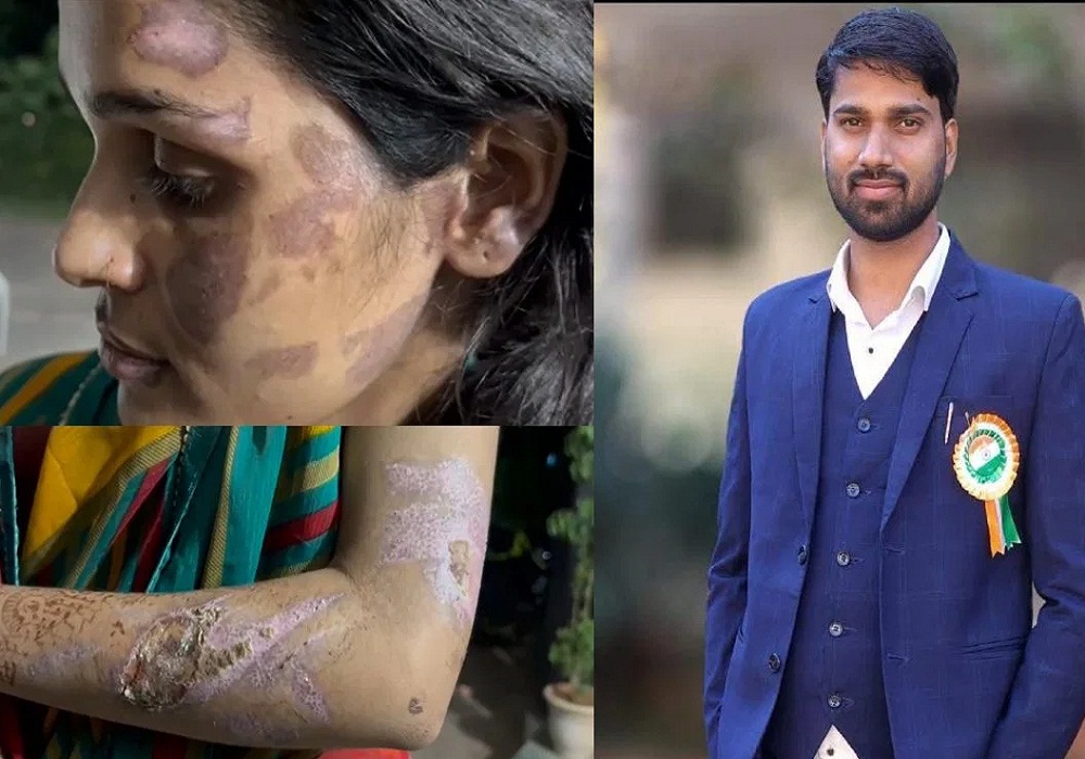 गर्म पानी में डुबोया चेहरा, मुंह में कपड़ा ठूंसकर चिमटा से जलाया.... पत्नी बोली- पति का दूसरी महिला से अवैध संबंध, सास-ससुर ने भी नहीं छोड़ा