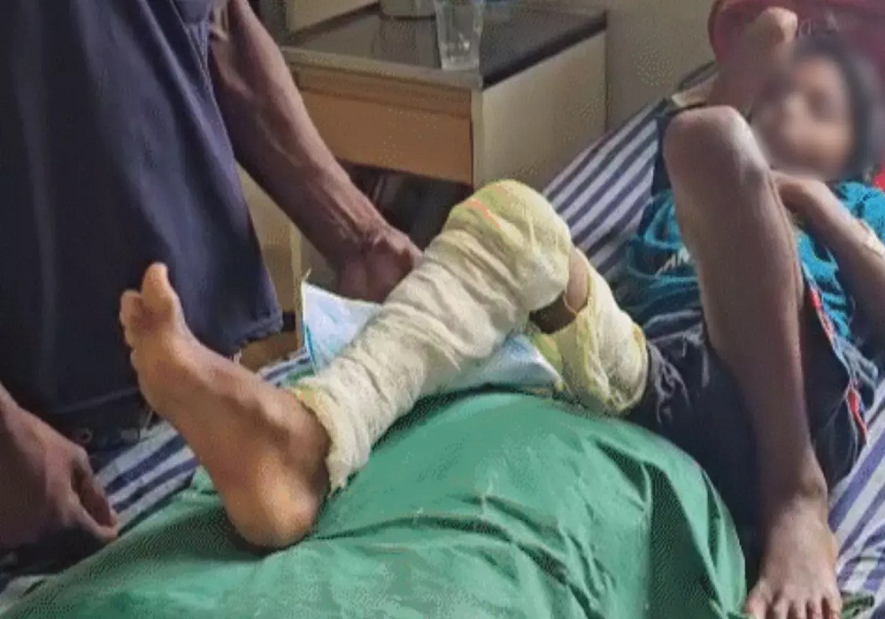 Headmaster beats up student: छात्रा को डंडे से पीटकर हेडमास्टर ने तोड़ा पैर, मासूम बोली - क्लास में बात करने पर पीटा… अस्पताल में भर्ती