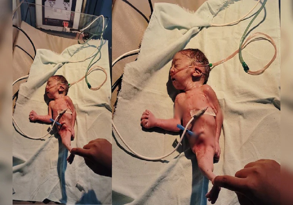 Jalpari Jaisa Baccha: छत्तीसगढ़ में हुआ 'जलपरी बेबी' का जन्म, देखकर डॉक्टर- नर्स भी रह गए हैरान… जानें आखिर क्या है मामला?
